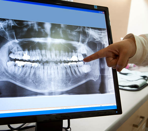 Dental x ray film for dental care concept